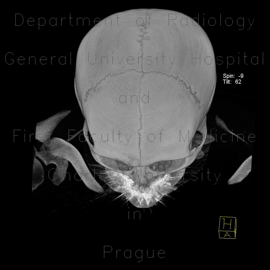 Metopic suture