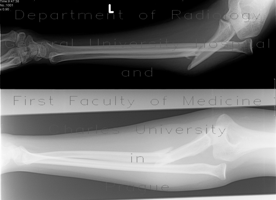 Monteggia fracture