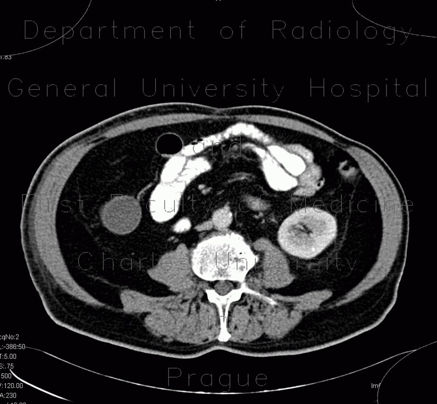 Mucocoele of appendix