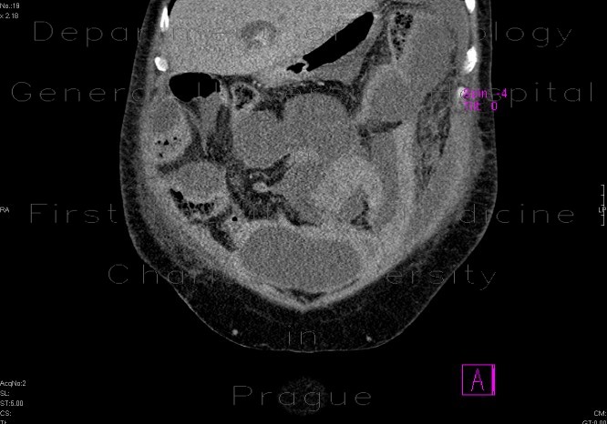 Multiple collections in the peritoneal cavity following stercoral peritonitis
