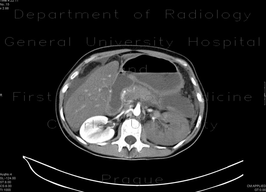 Multiple visceral thromboses of unknown etiology