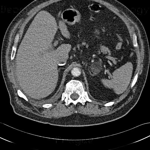 Myelolipoma of adrenal gland