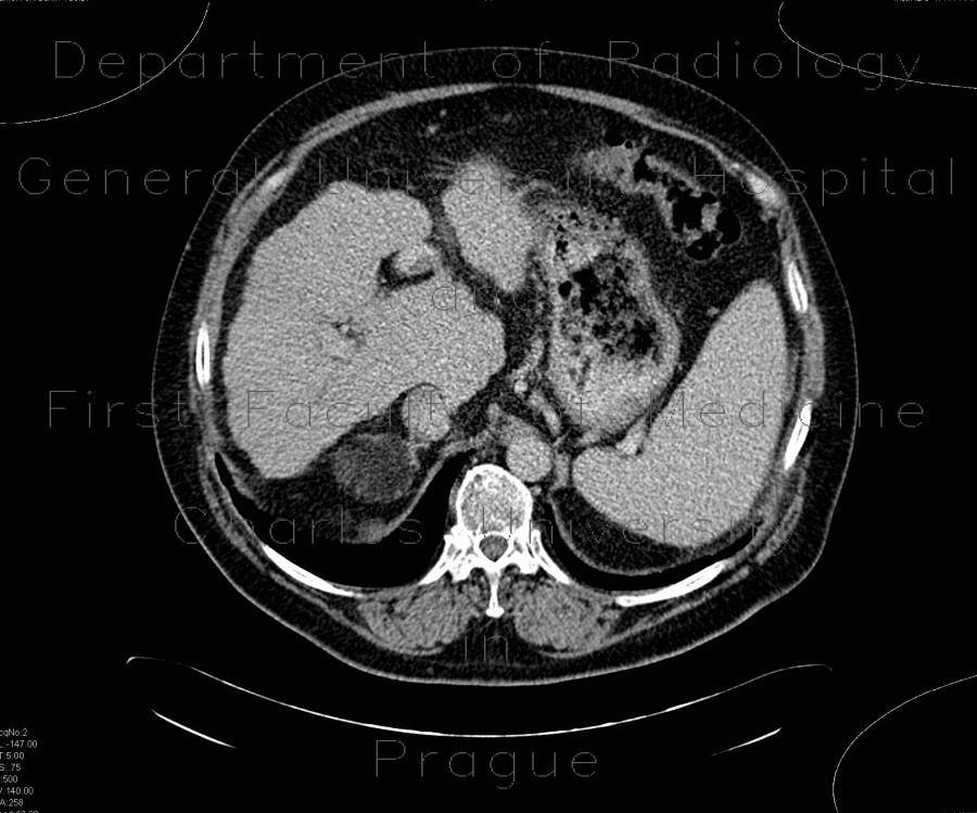 Myelolipoma of adrenal gland, liver cirrhosis, portal vein thrombosis