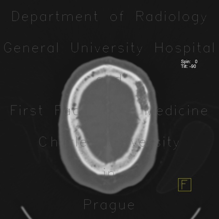 Myeloma of orbit and skull