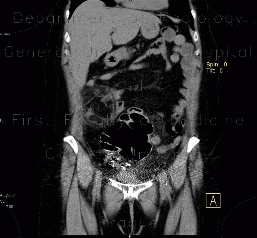 Necrosis of mesenteric fat, postoperative, colectomy