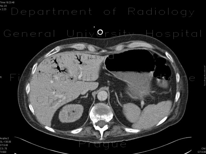 Necrotizing enterocolitis, gas in portal vein