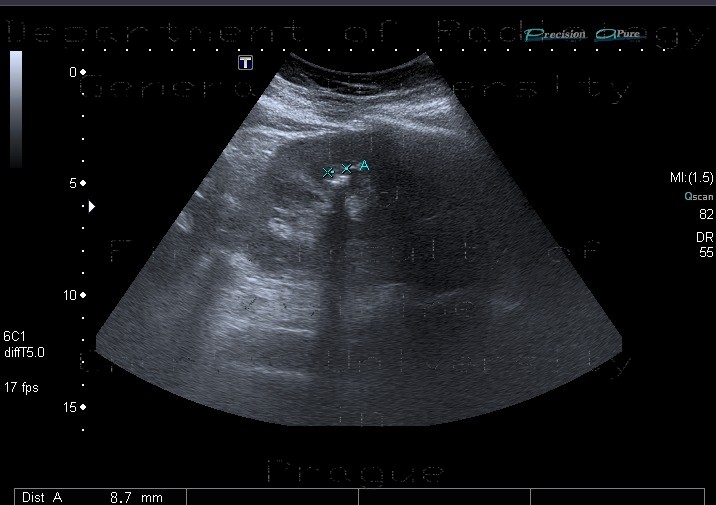 Nephrolithiasis, kidney stone