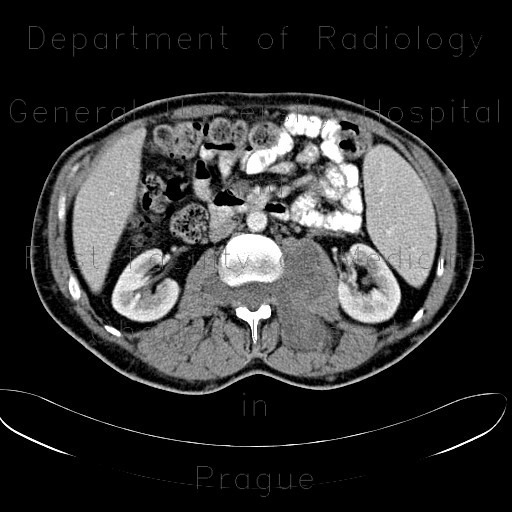 Neurofibromatosis, type I, von Recklinghausen disease, neurofibroma