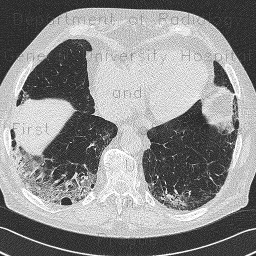 Non-specific interstitial pneumonia, NSIP, interstitial pneumonia