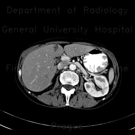 Nutcracker syndrome, aortomesenteric compression