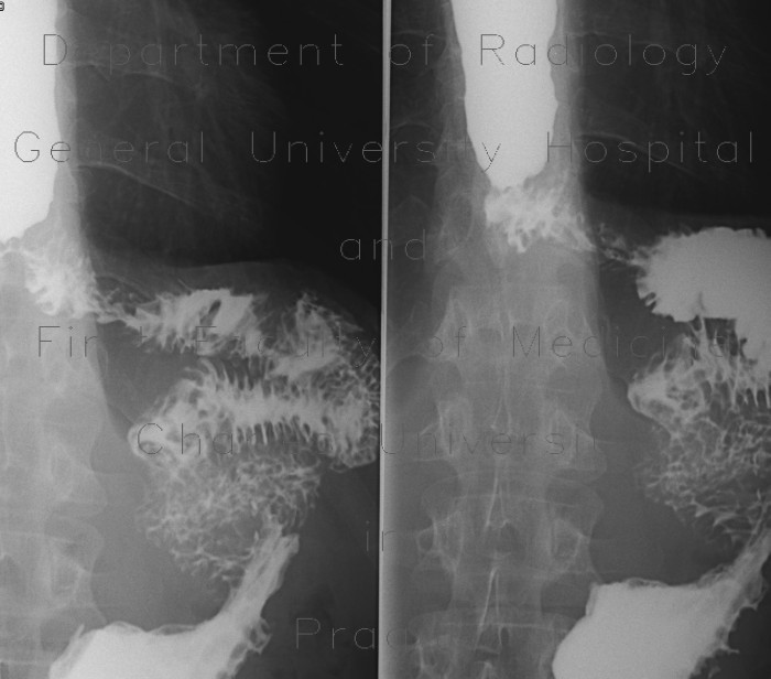 Oesophageo-jejunal anastomosis