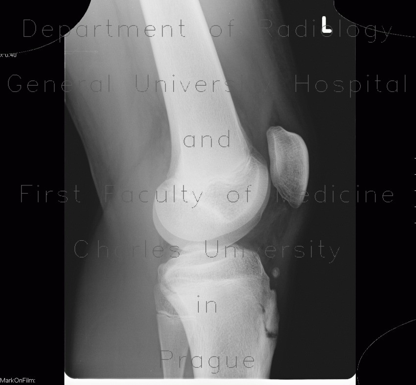 Osgood-Schlatter, aseptic necrosis of tibial tuberosity