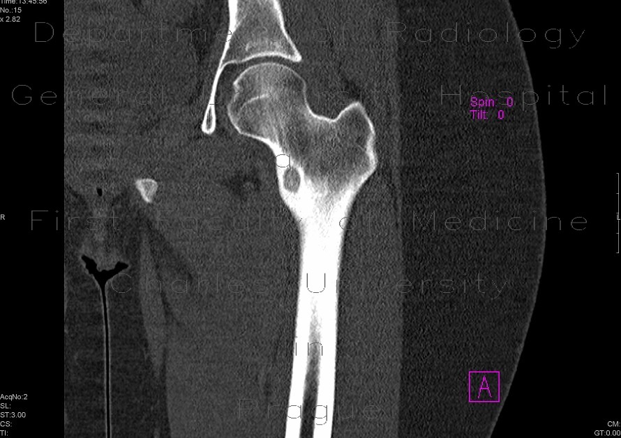 Osteoid osteoma