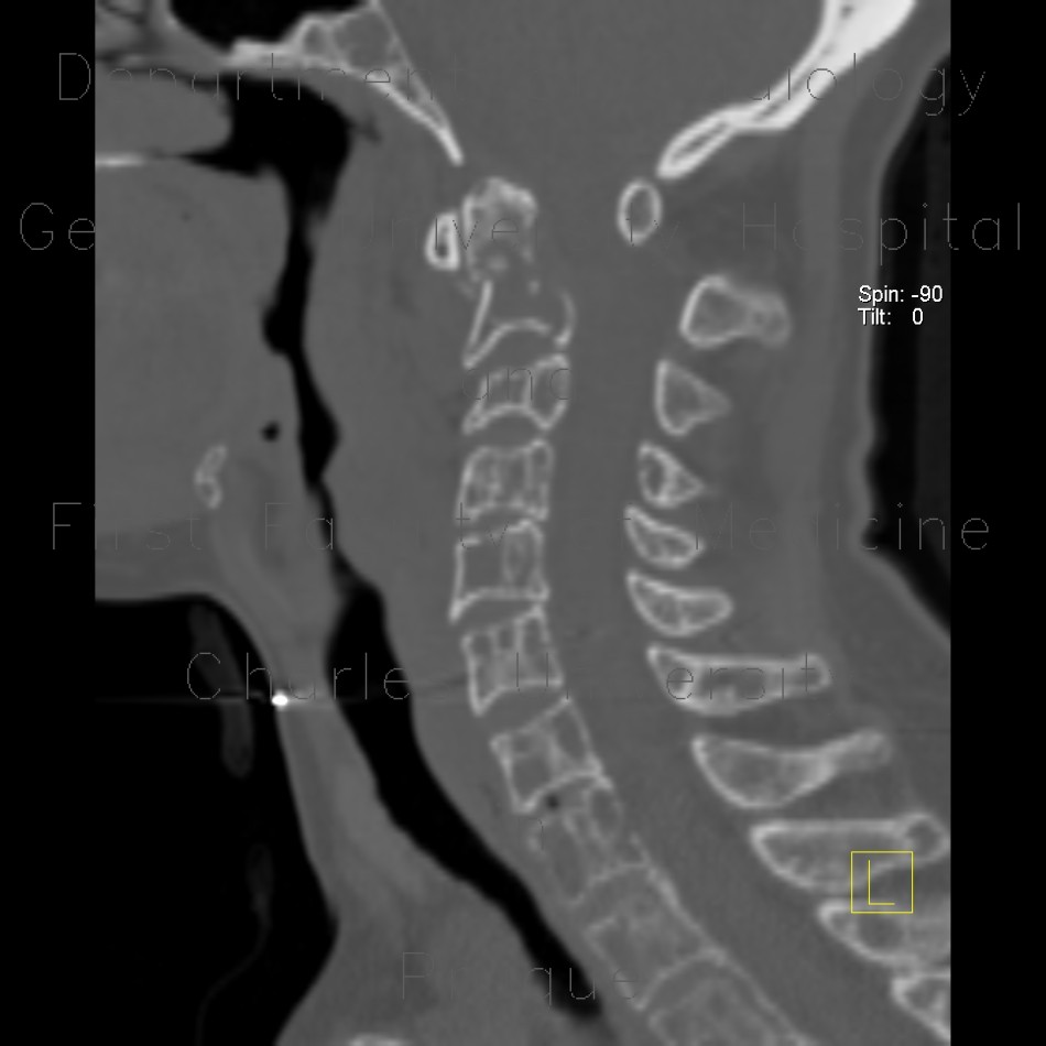 Osteolytic metastasis of cervical spine, fracture of dens axis, C2