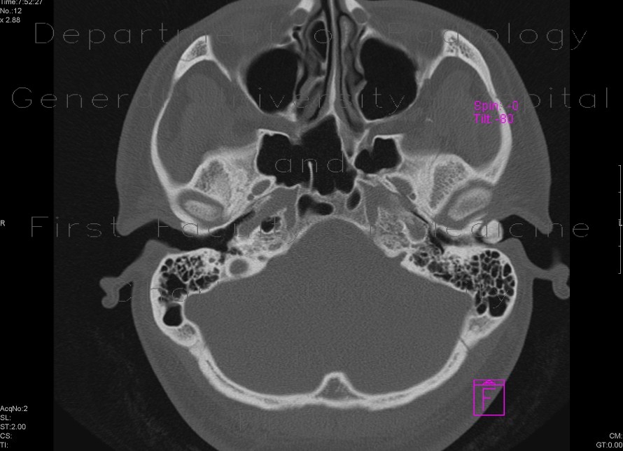 Osteoma of external auditory meatus