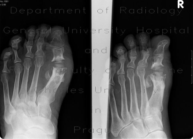 Osteomyelitis of first metatarsophalangeal joint, MTP joint replacement