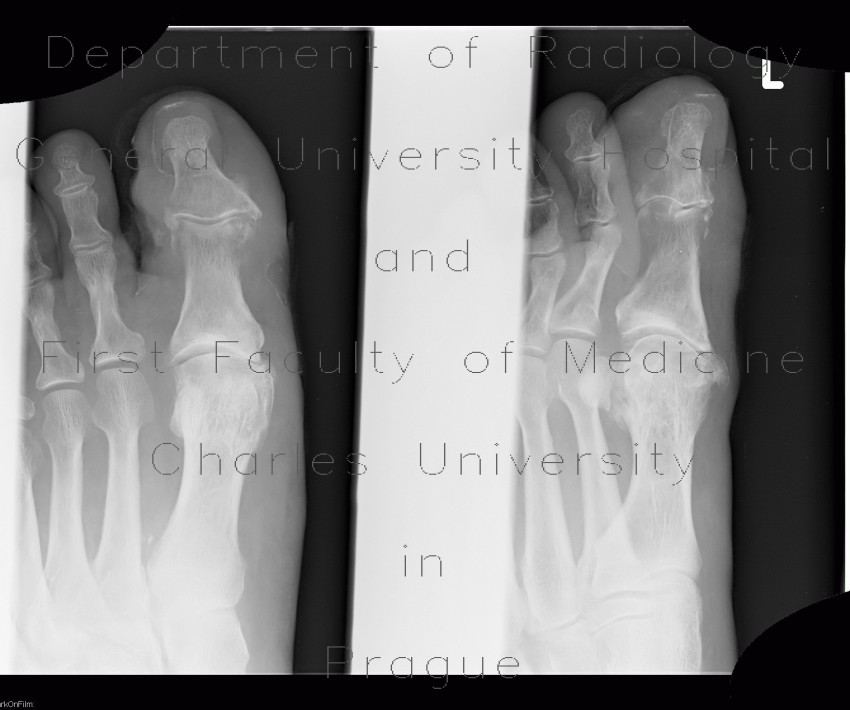 Osteomyelitis of the toe
