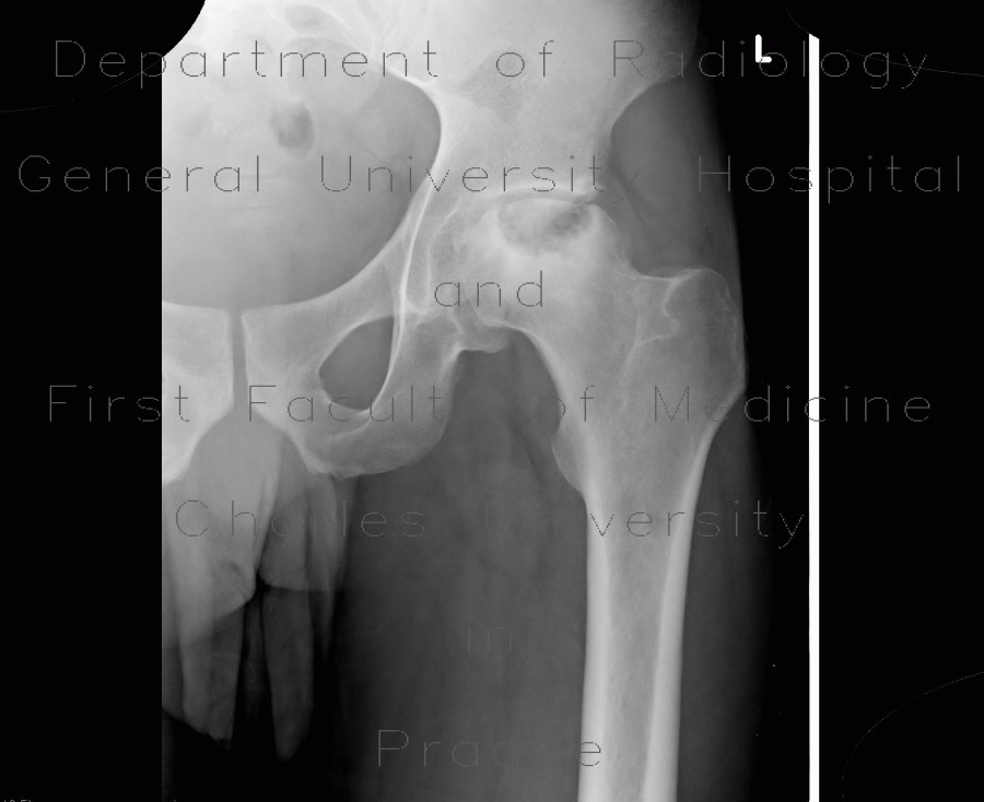 Osteonecrosis of head of femur