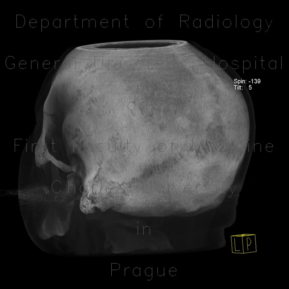 Osteoplastic metastases, prostate cancer