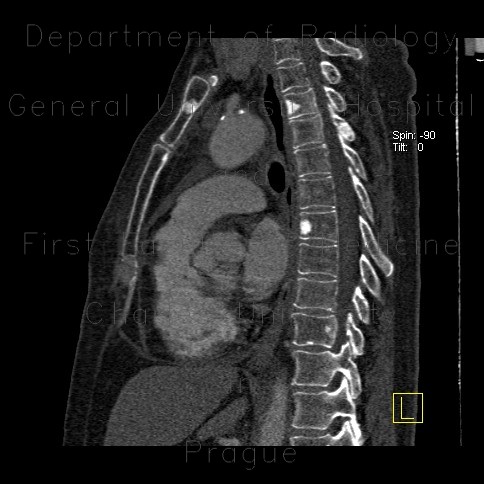 Osteoplastic skeletal metastases, breast carcinoma