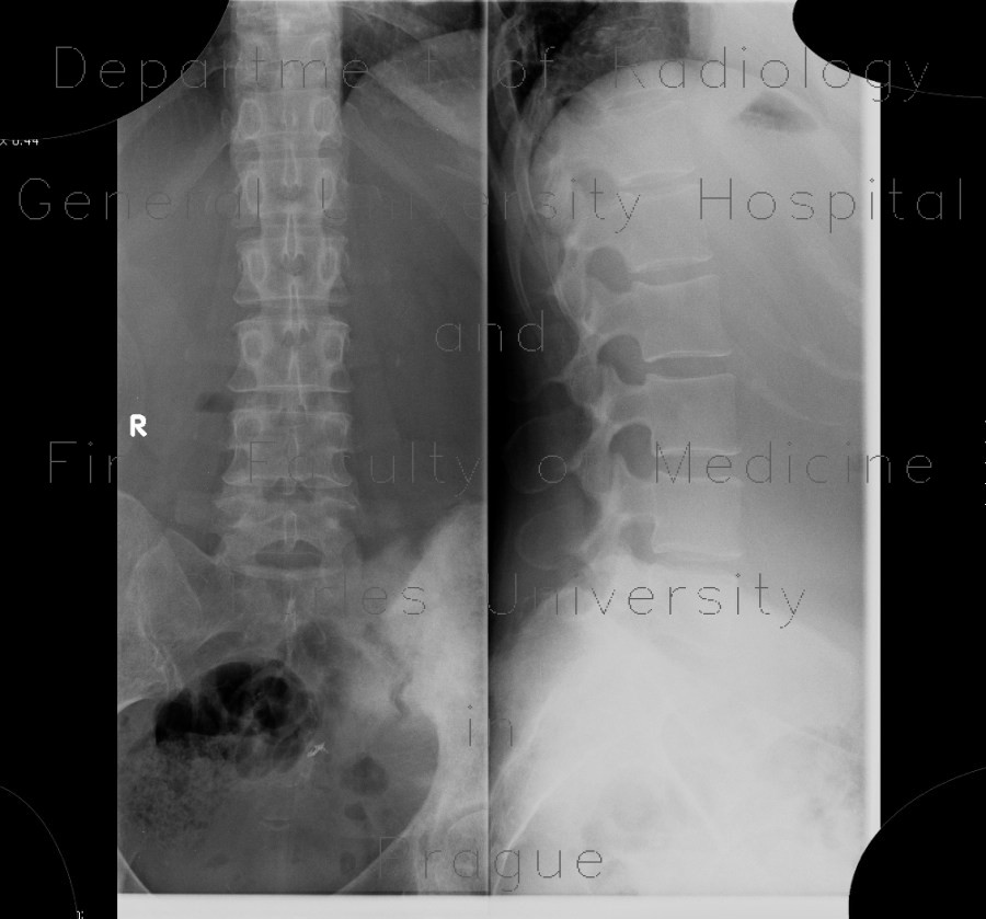 Osteosarcoma of pelvis, bone tumour