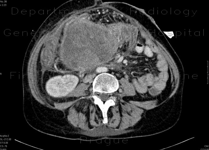 Ovarial carcinoma, peritoneal carcinomatosis