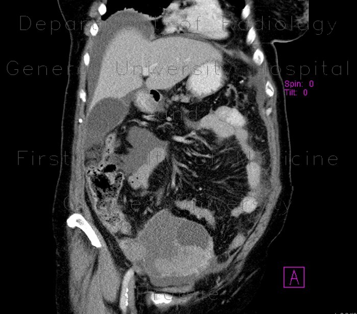 Ovarian carcinoma, carcinomatosis