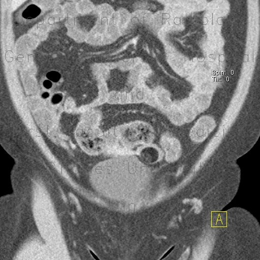 Ovarian teratoma