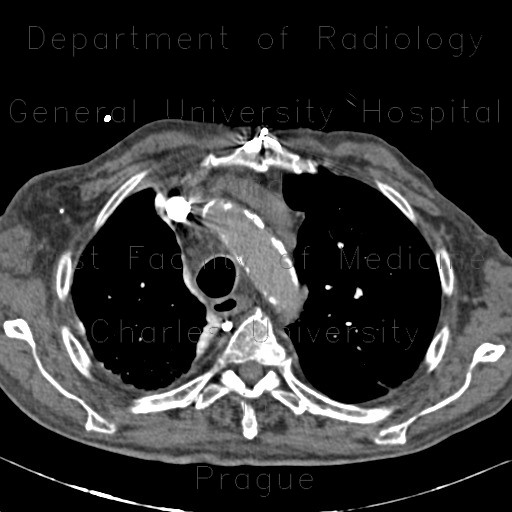 Pachypleuritis after talc pleurodesis