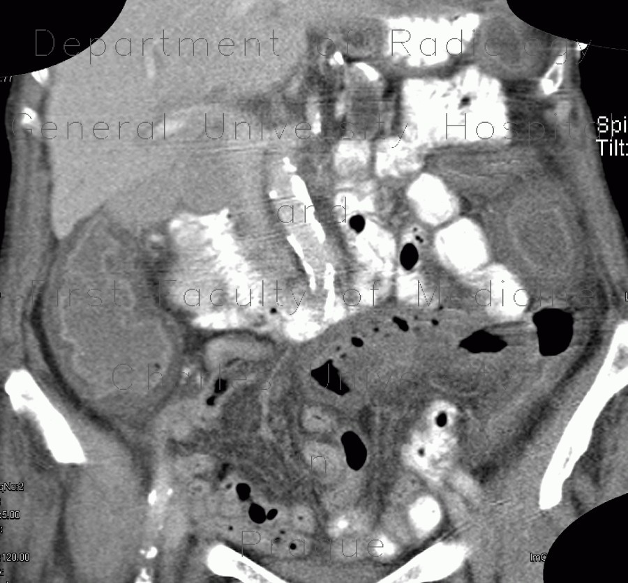Pancolitis, acute colitis, colitis