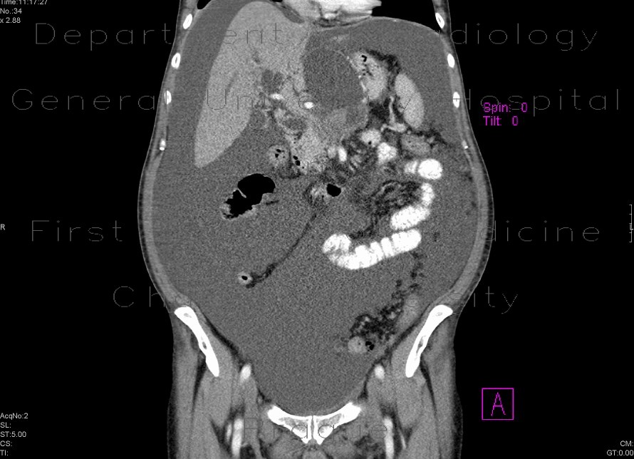 Pancreatic carcinoma, carcinomatous peritonitis, ascites