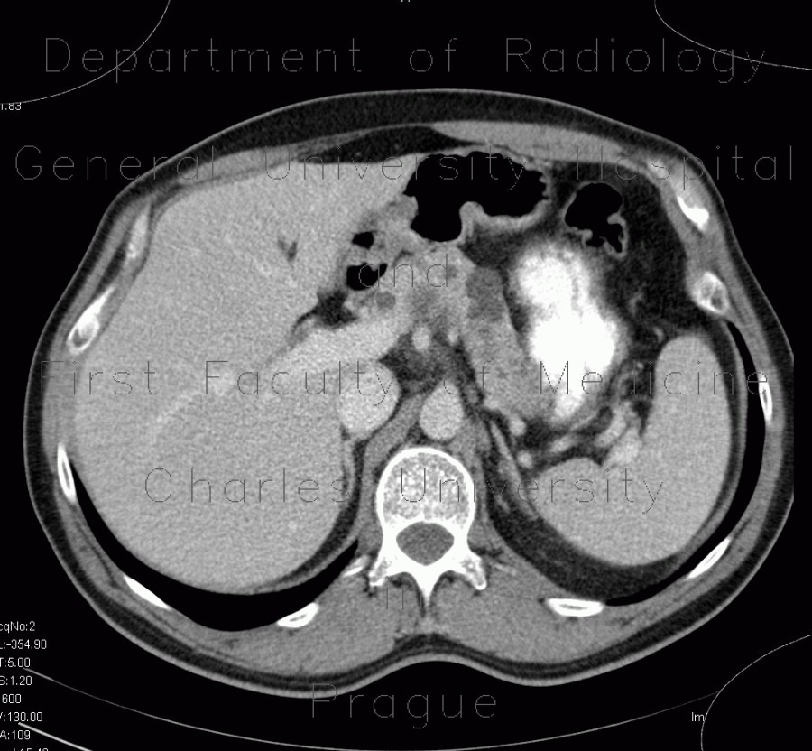 Pancreatic cysts and renal cysts in von Hippel-Lindau disease