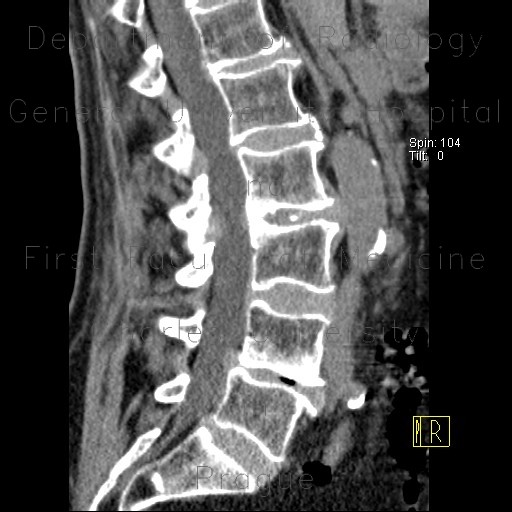 Paramedial protrusion of intervertebral disc, lumbar spine