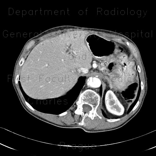 Parenchymal bleeding in liver after PTC (percutaneous transhepatic cholangiography) - before