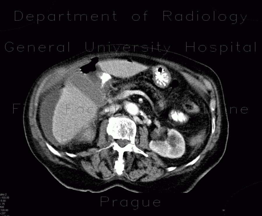 Perforation of gastric ulcer, stomach ulcer