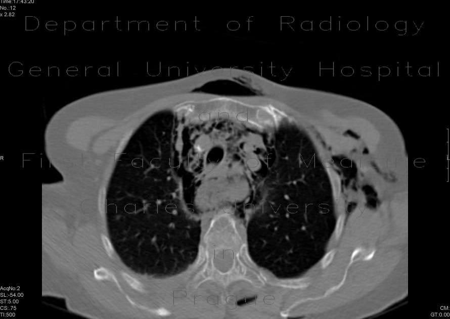 Perforation of oesophagus, pneumomediastinum