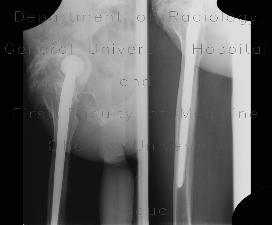Periarticular ossifications after replacement of hip joint, pseudoarthrosis, false joint