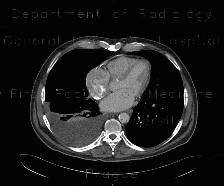 Pericardial calcification, calcified pericarditis, pericarditis calcarea