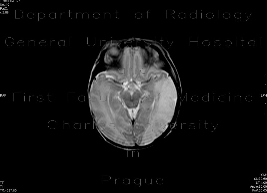 Perinatal thrombosis of the left middle cerebral artery, MCA