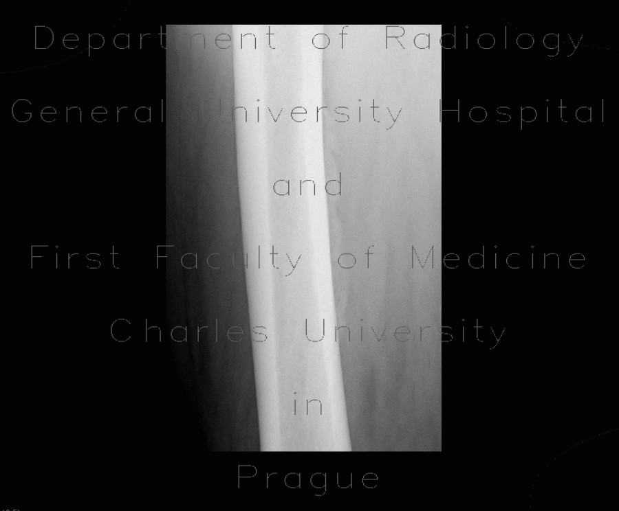 Periostosis of femur