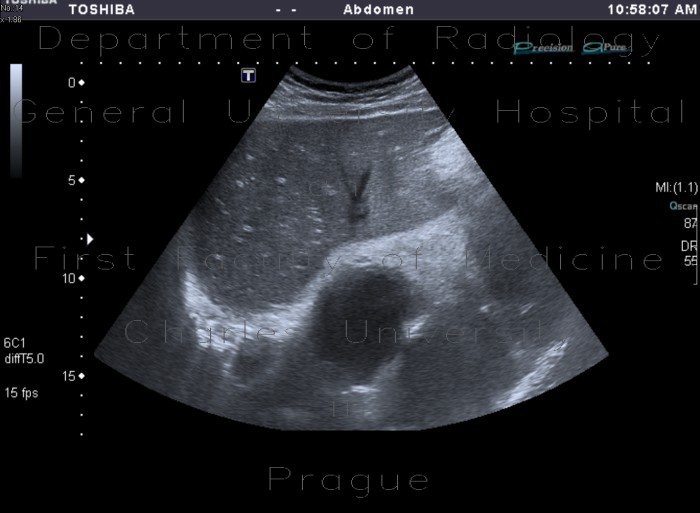 Periportal fibrosis
