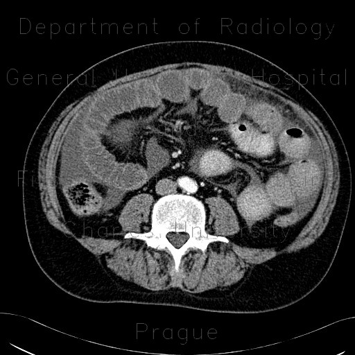Peritoneal dialysis, complication, fluid collection, gigantic, before