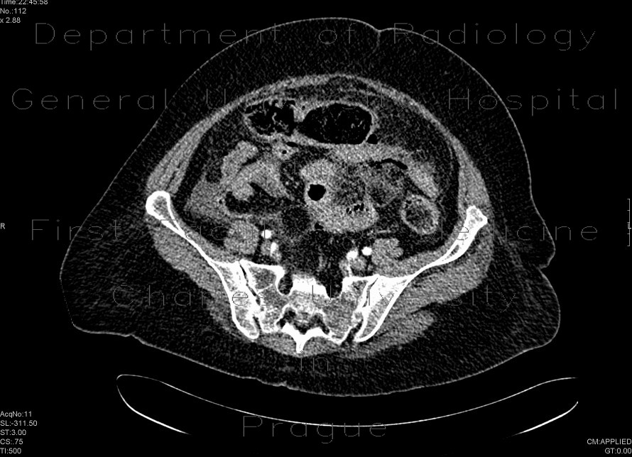 Peritonitis, perforation of large bowel