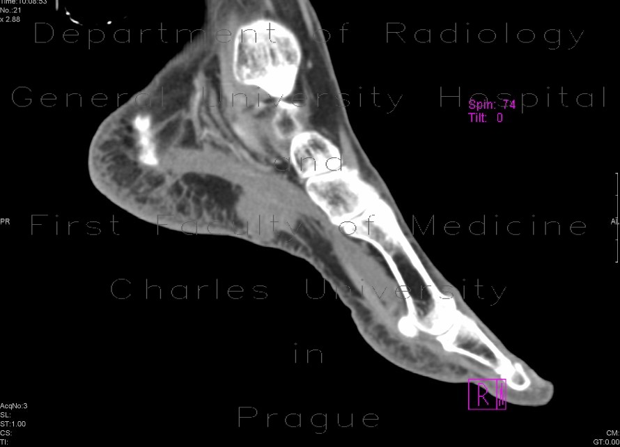 Plantar lymphoma