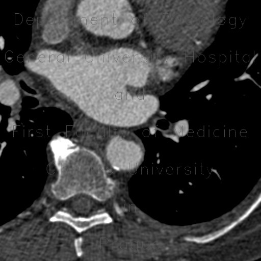 Plaques in the thoracic aorta, lipid