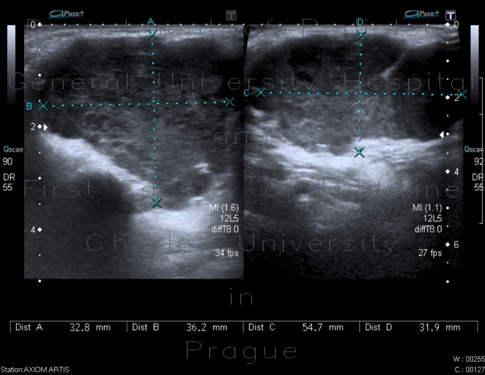 Pleomorphic adenoma, parotid gland