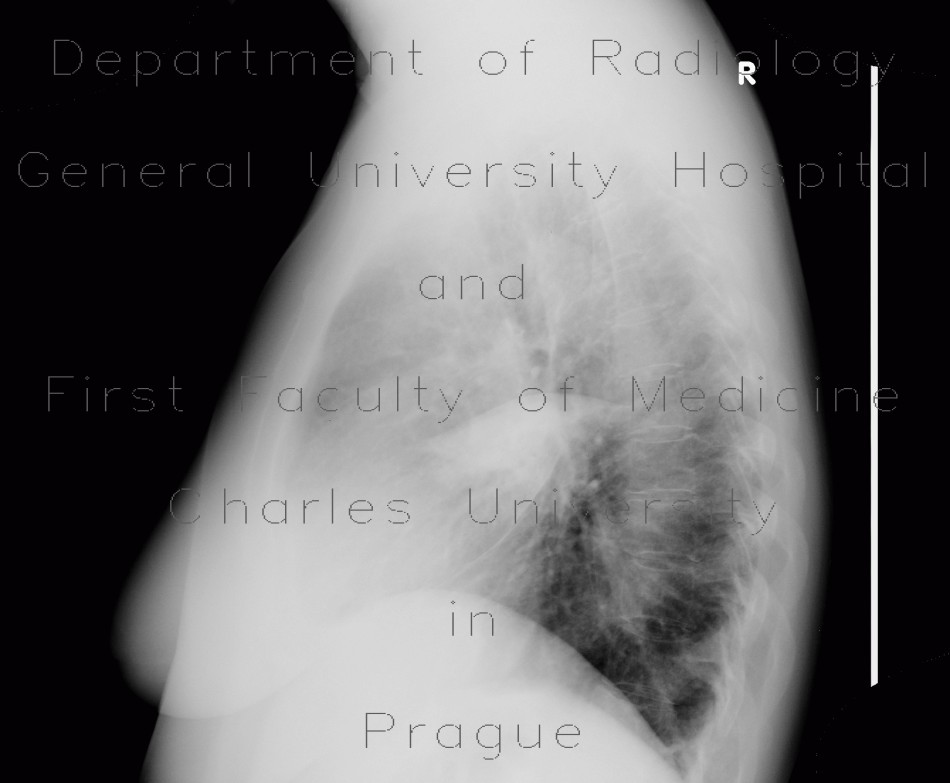 Pleural effusion, loculated, fissure