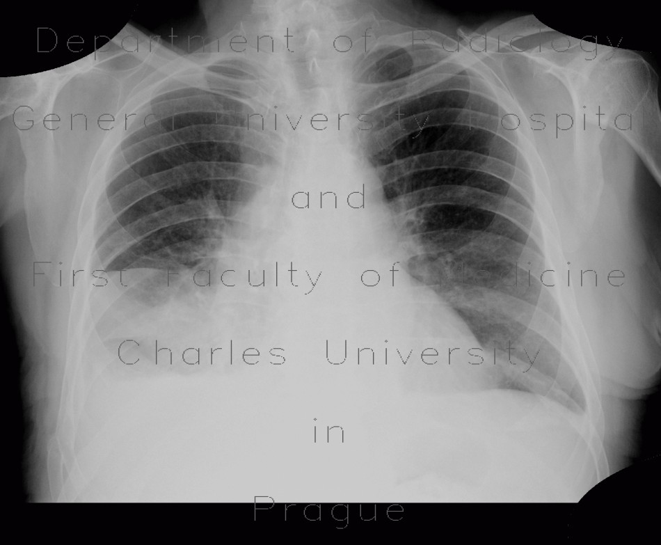 Pleural effusion, subpulmonal