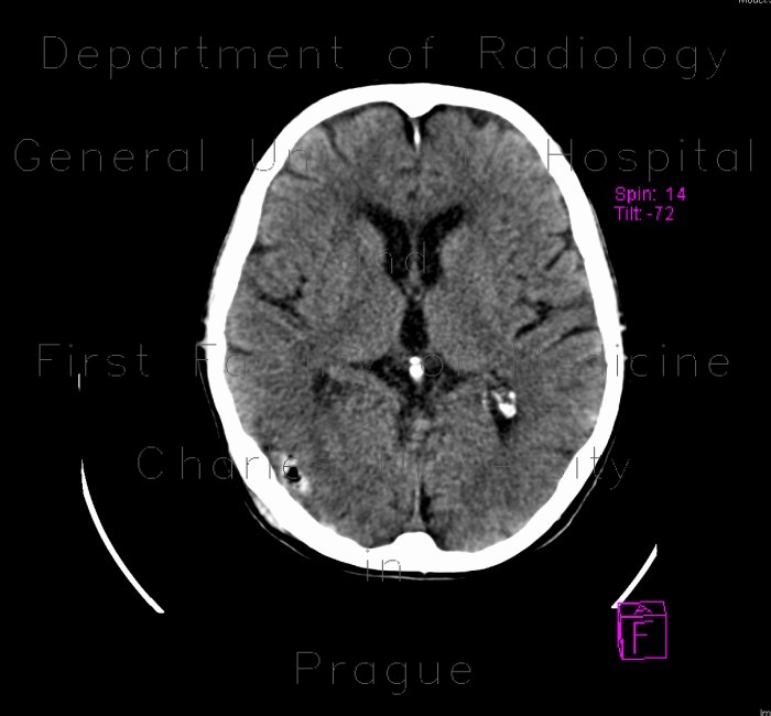 Pneumocephalus