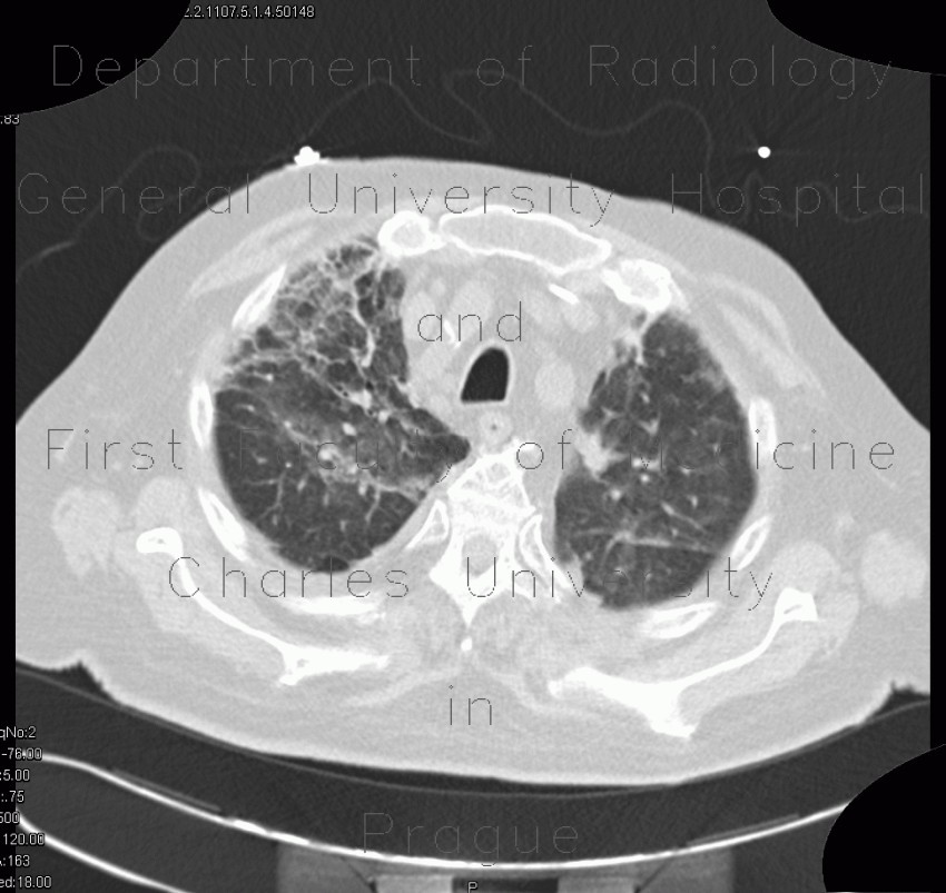 Pneumocystis carinii, HRCT
